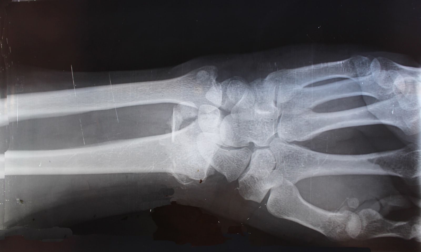 Radiografía de muñeca que muestra la estructura ósea